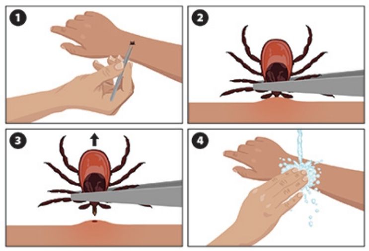 how to remove a tick